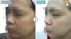Singapore / Glutathione injection