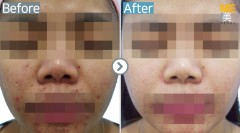 Singapore / Glutathione injection