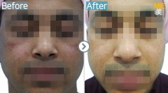 Singapore / Glutathione injection