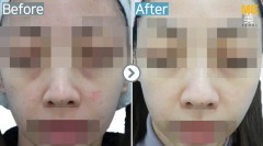 Singapore / Glutathione injection
