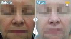 Singapore / Glutathione injection