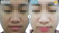 Singapore / Glutathione injection