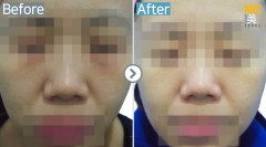 Singapore / Glutathione injection
