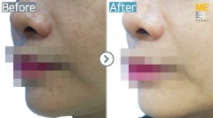 Singapore / Glutathione injection
