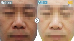 Singapore / Glutathione injection