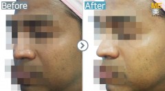 Singapore / Glutathione injection