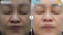 Singapore / Glutathione injection
