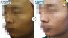 Singapore / Glutathione injection