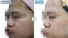 Singapore / Glutathione injection