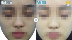 Singapore / Glutathione injection