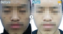 Singapore / Glutathione injection