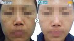 Singapore / Glutathione injection