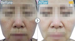 Singapore / Glutathione injection