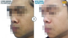 Singapore / Aqua peel