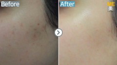 Singapore / Aqua peel