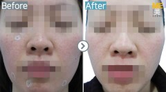 Singapore / Mole removal