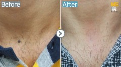 Singapore / Mole removal