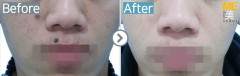 Singapore / Mole removal