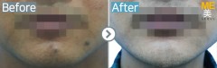 Singapore / Mole removal
