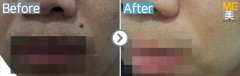 Singapore / Mole removal