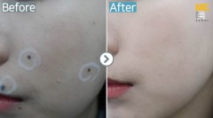 Singapore / Mole removal