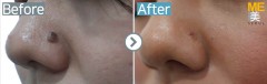 Singapore / Mole removal