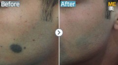 Singapore / Mole removal