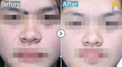 Singapore / Mole removal