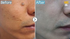 Singapore / Mole removal