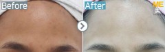 Singapore / Acne (PDT)