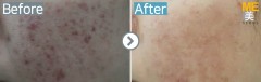 Singapore / Acne (V-PDT)