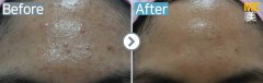 Singapore / Acne (PDT)