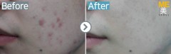 Singapore / Acne (Synergy MPX)