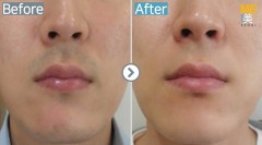 Singapore / Upper lips & chin