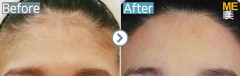 Singapore / Forehead
