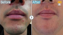 Singapore / Upper lips & chin