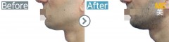 USA / Philtrum size reduction