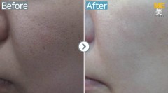 Singapore / Acne scar (Legato)