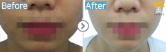 Singapore / Acne scar (Legato)