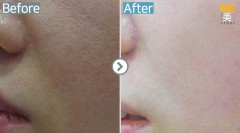 Singapore / Acne scar (Legato)