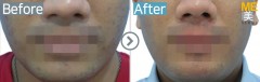 Singapore / Acne scar (MTS & PRP)