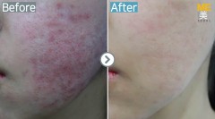 Singapore / Acne scar (Fraxel & PRP)