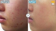 Singapore / Acne scar (Fraxel & PRP)