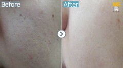 Singapore / Acne scar (MTS & PRP)