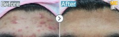 Singapore / Acne scar (MTS & PRP)