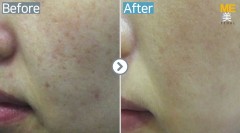 Singapore / Acne scar (Legato)