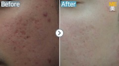 Singapore / Acne scar (Legato)