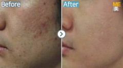 Singapore / Acne scar (Legato)