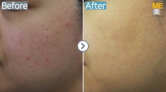 Singapore / Acne scar (Legato & PRP)