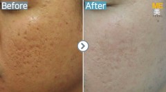 Singapore / Acne scar (Legato & PRP)